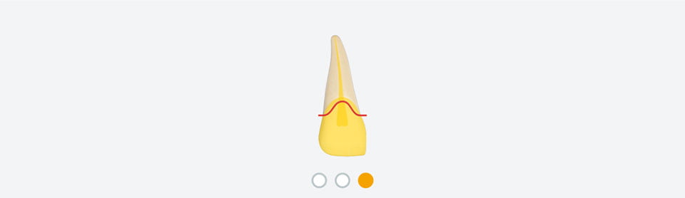 EM Dental problem overview root canal