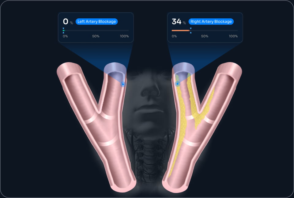 Artery Blockage Representation