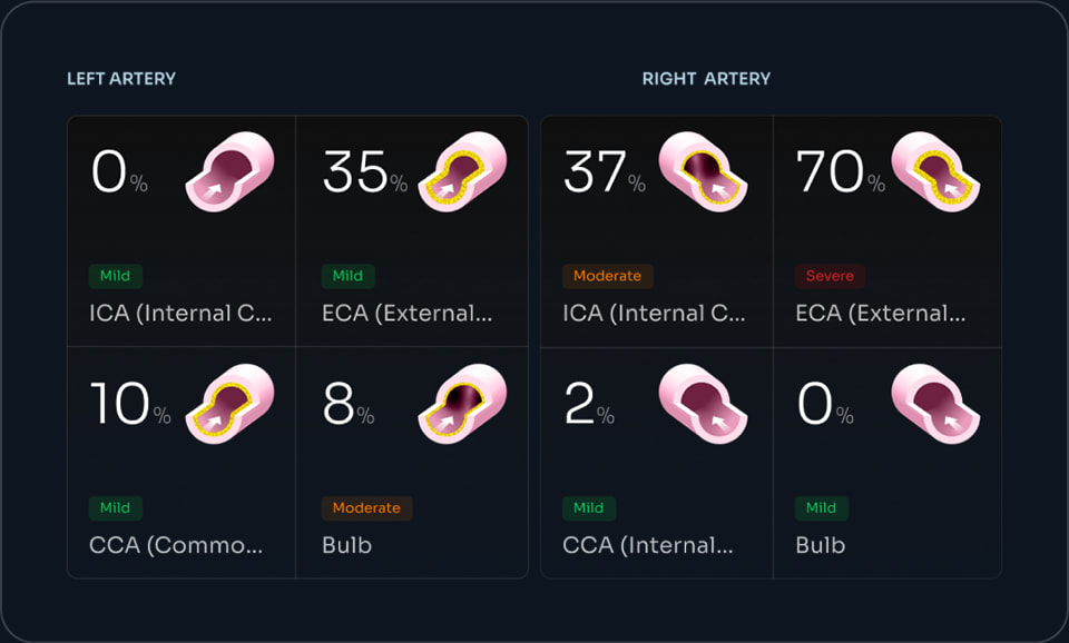 Artery Blockage