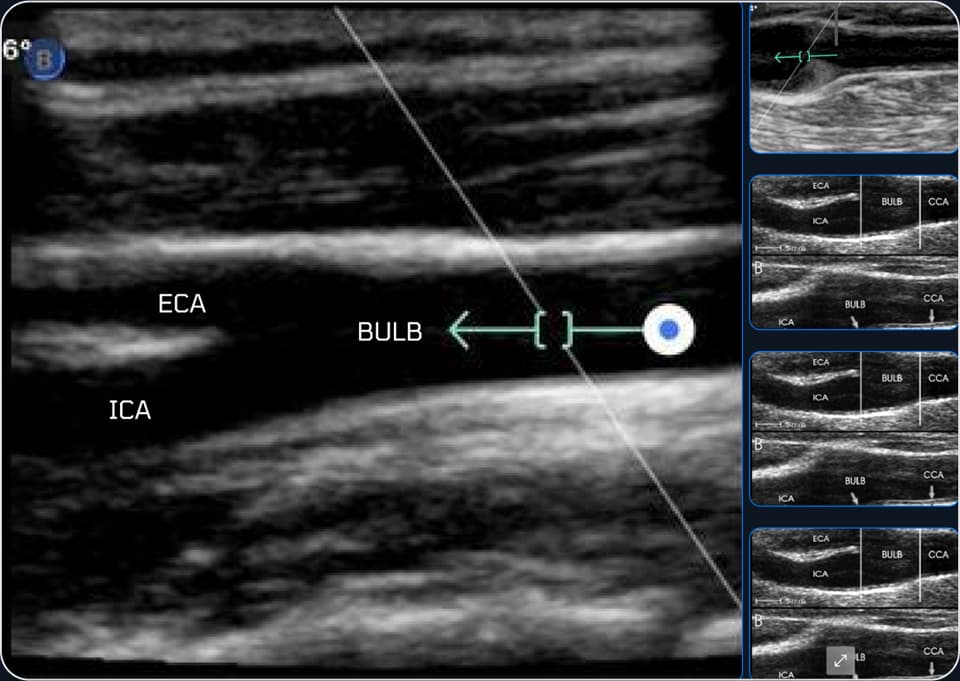 Intuitive Artery UI: Simplifying Blockage Assessment for All